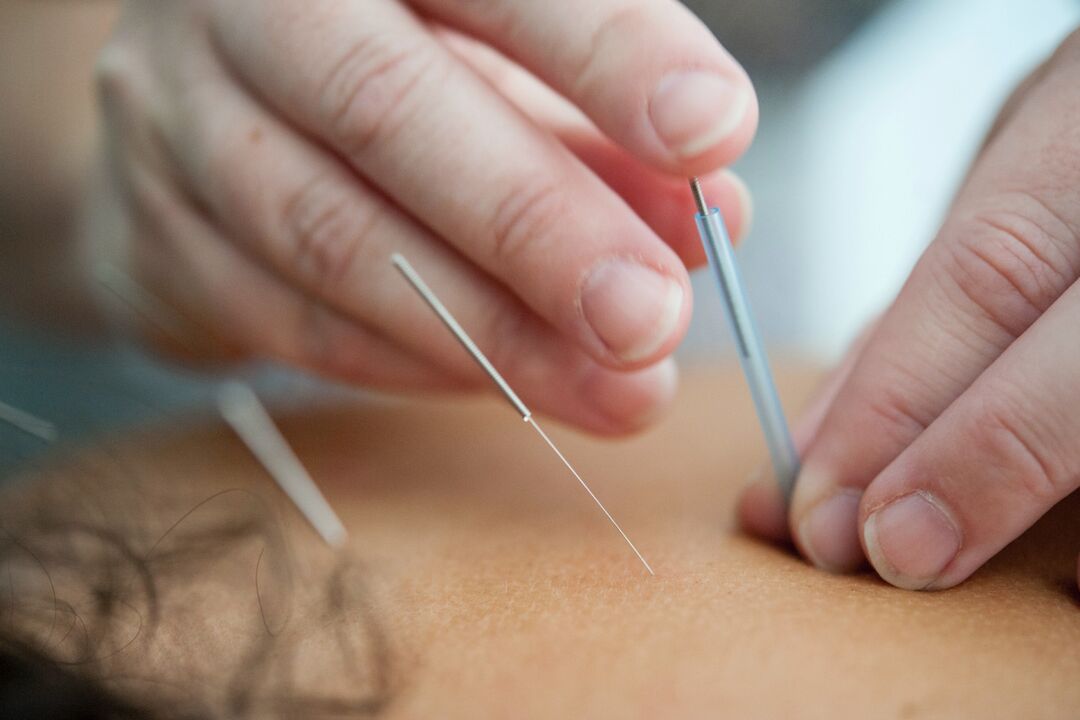 L'acupuncture est un moyen inefficace d'arrêter de fumer