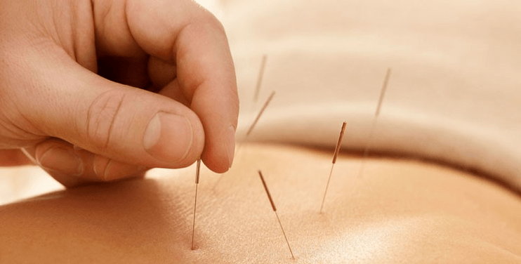 acupuncture contre le tabagisme